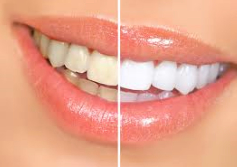Before and after teeth whitening result