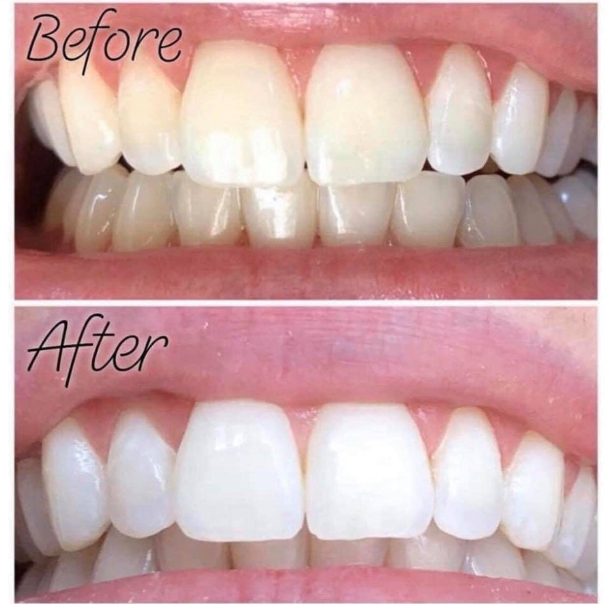 Before and after teeth whitening result