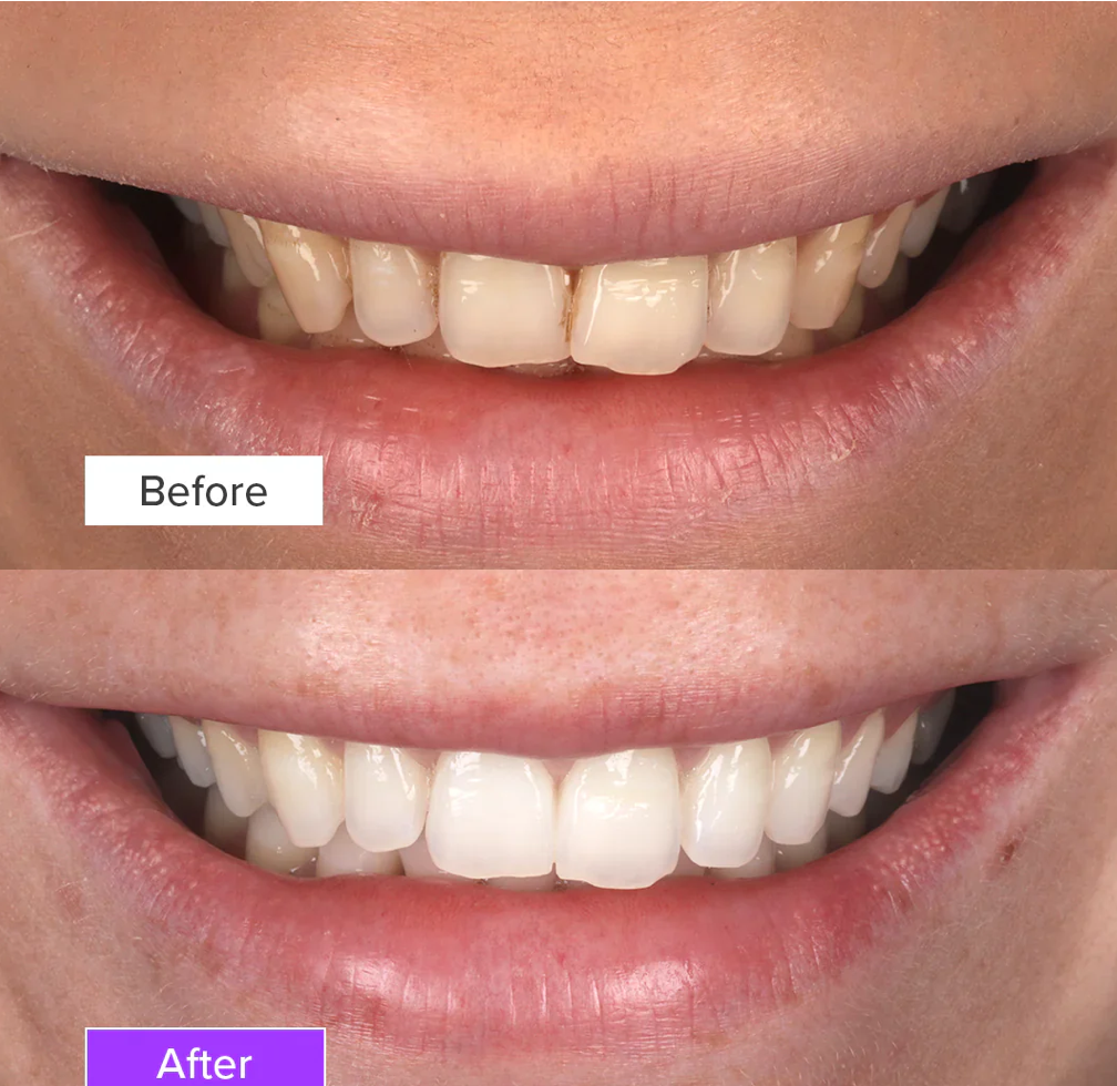 Before and after teeth whitening result