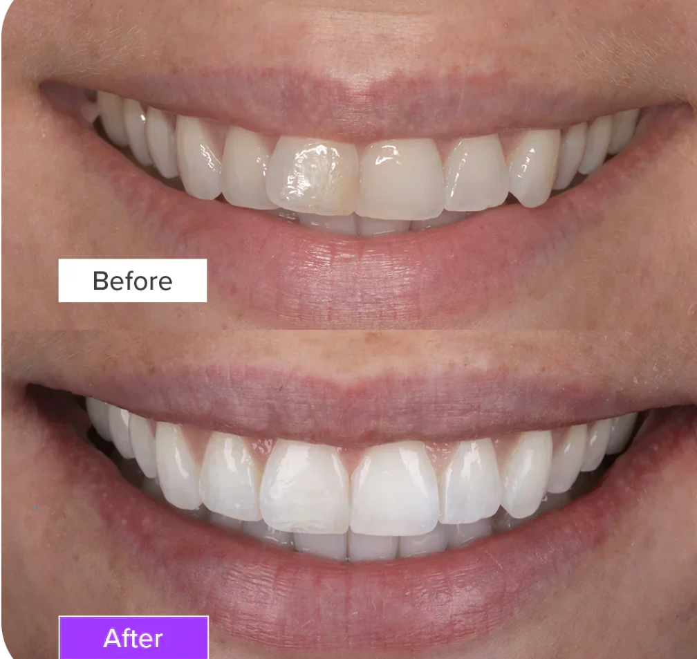 Before and after teeth whitening result
